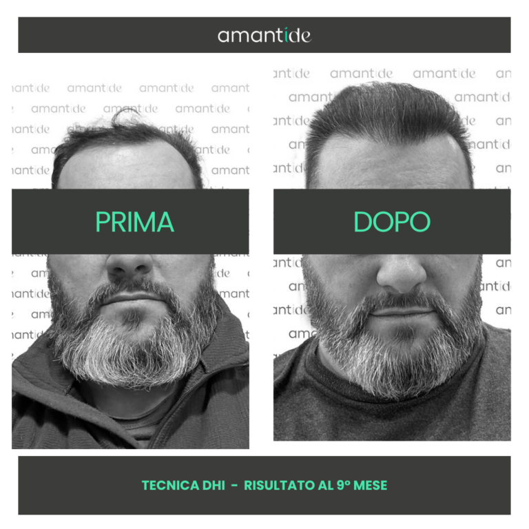 trapianto di capelli in turchia amantide vicenza 3