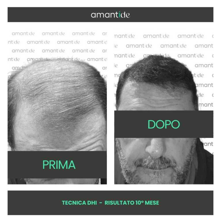 trapianto di capelli in turchia amantide vicenza