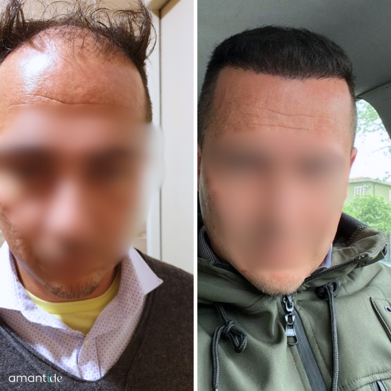 trapianto capelli prima e dopo amantide